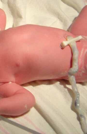 Umbilical cord