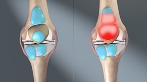 3D image showing normal bursa (left) and bursitis (right) 3D still showing Bursitis.jpg