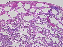 hypersensitivity pneumonitis mechanism