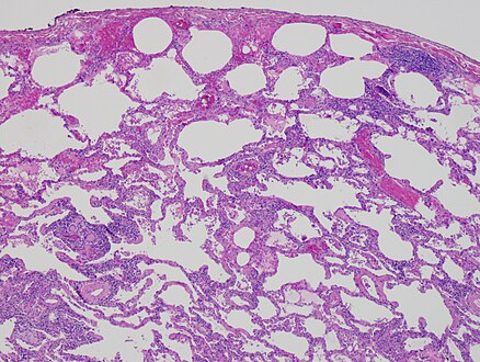 Low magnification view of the histology of chronic hypersensitivity pneumonitis. The interstitium is expanded by a chronic inflammatory infiltrate. Two multinucleated giant cells can be seen within the interstitium at left, and a plug of organizing pneumonia at bottom left.