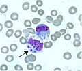 Thumbnail for Human monocytotropic ehrlichiosis