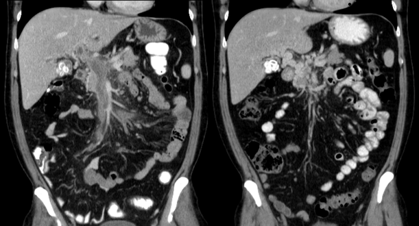 Portal vein thrombosis on computed tomography (left) and cavernous transformation of the portal vein after 1 year