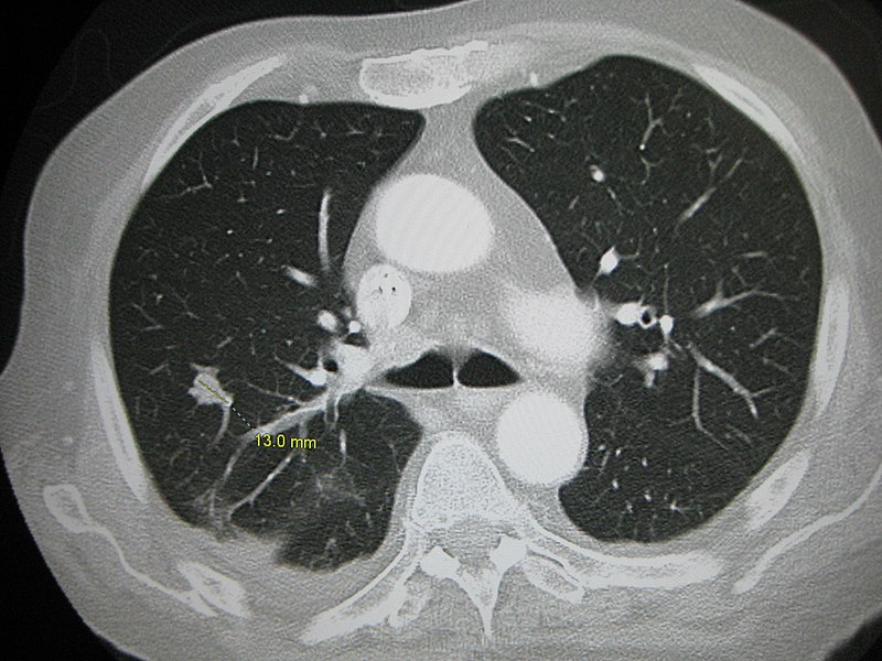 Рак молочной железы метастазы в легких. Мультиспиральная компьютерная томография (МСКТ). Кт легких с контрастом. Мультиспиральная кт легких.