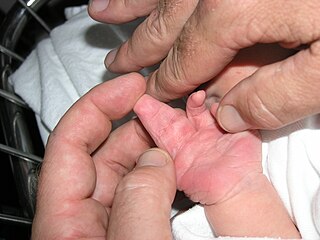 New born boy showing complete complex syndactyly with two fingers right hand.JPG