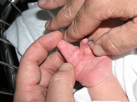 يد طفل وليد تظهر ارتفاق الأصابع المعقد التام لإصبعين من أصابع اليد.