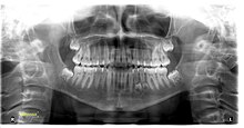 A set of human teeth under an orthopantomogram Orthopantomogram showing supernumerary teeth.jpg