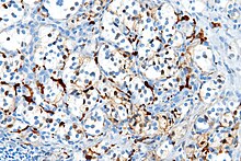 S100 immunostain marking the sustentacular cells in a paraganglioma Paraganglioma - s100 - very high mag.jpg