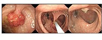 Polyp is identified, snare is passed over stalk and polyp is then removed Polypectomy.jpg