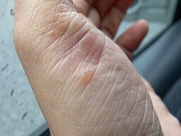 A man's hand with pustular psoriasis. The skin on the hand is red and inflamed, with small, raised, yellow-white pustules. The pustules are surrounded by a red ring