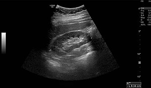 Right kidney seen on abdominal ultrasound.jpg