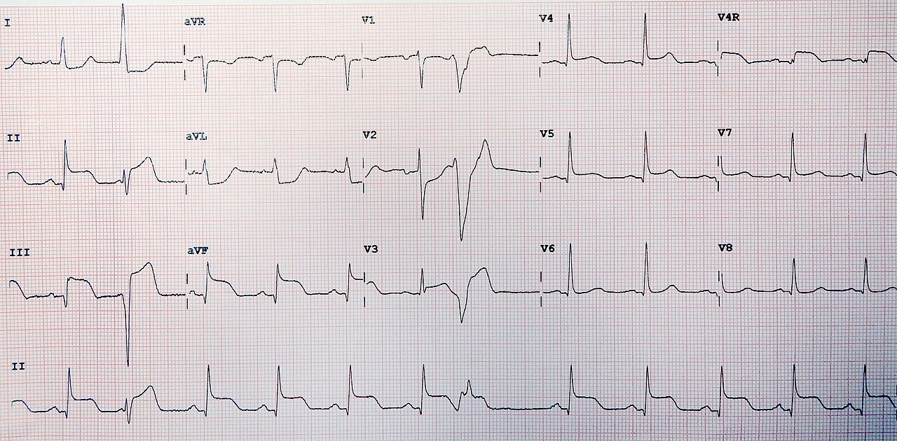 st segment elevation myocardial infarction