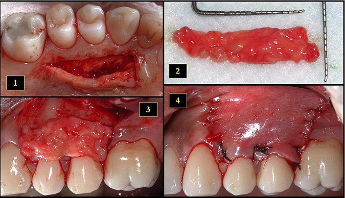 Ipsilateral palatal mucosa serving as the donor site
The retrieved connective tissue, approximately 25 x 6 mm in dimension
Connective tissue placed at recipient site
Recipient site flap coronally advanced and sutured to entirely cover the graft Subepithelial graft.jpeg