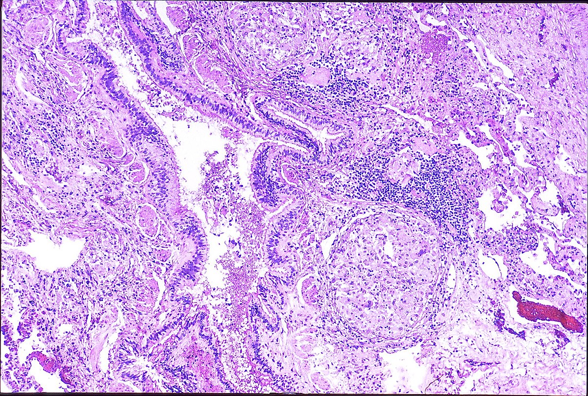 cirrhosis of the liver related to cancer