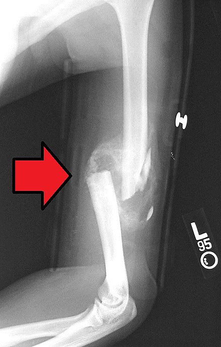 Comminuted midshaft humerus fracture with callus formation. Communitive midshaft humeral fracture callus.jpg