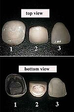 Thumbnail for Veneer (dentistry)