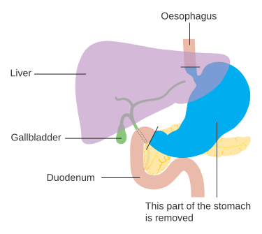 File:Diagam showing the anatomy before Roux-en-y surgery for stomach cancer CRUK 002.svg