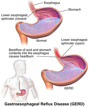 Gastroesophageal Reflux Disease