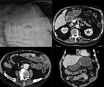 Gallensteinileus 86M - CR und CT - 001.jpg