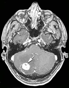 Hemangioblastom cerebelos.jpg