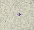 Hemoglobin H disease.jpg