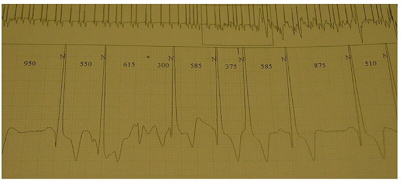 File:Morbus Fabry EKG 02.jpg