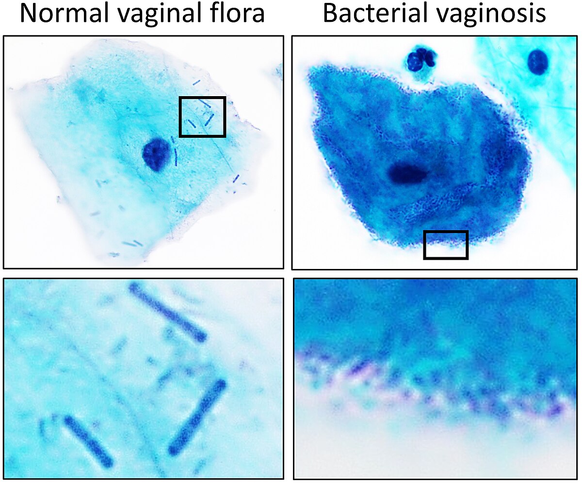 bacterial vaginosis gram stain