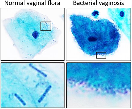 Vaginal squamous cell with normal vaginal flora versus bacterial vaginosis on Pap stain