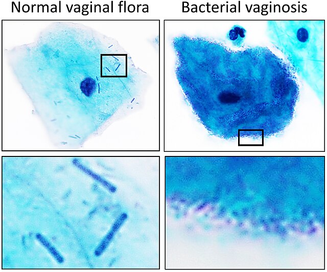 Bacterial vaginosis - Wikipedia