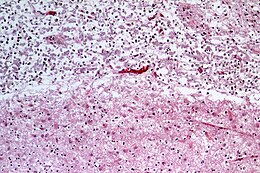 Image of gliosis2 in tissue