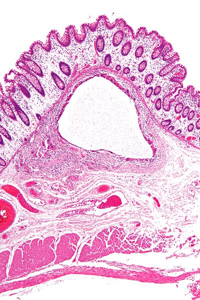 File:Pneumatosis cystoides intestinalis - low mag.jpg