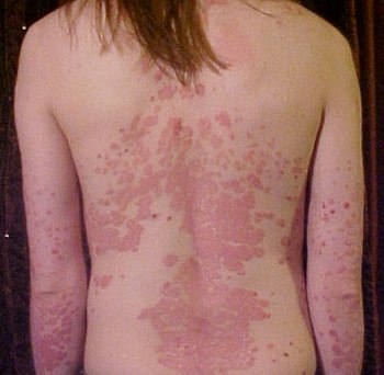 Psoriasis of the back.