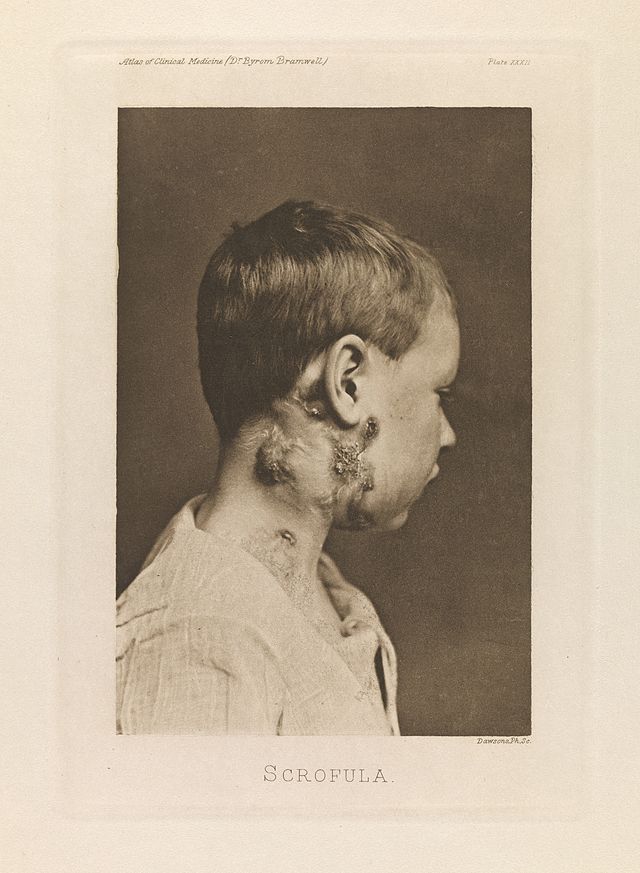 Description de l'image Scrofulous enlargement of the cervical and axillary glands. Wellcome L0076912.jpg.