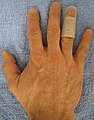 An example of a splint for mallet finger.
