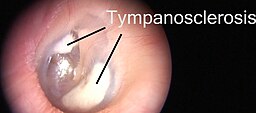 <span class="mw-page-title-main">Tympanosclerosis</span> Medical condition