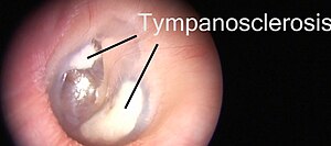 otosclerosis otoscopy