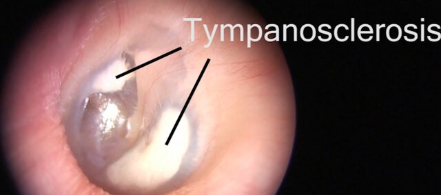 Tympanosclerosis – Oto Surgery Atlas