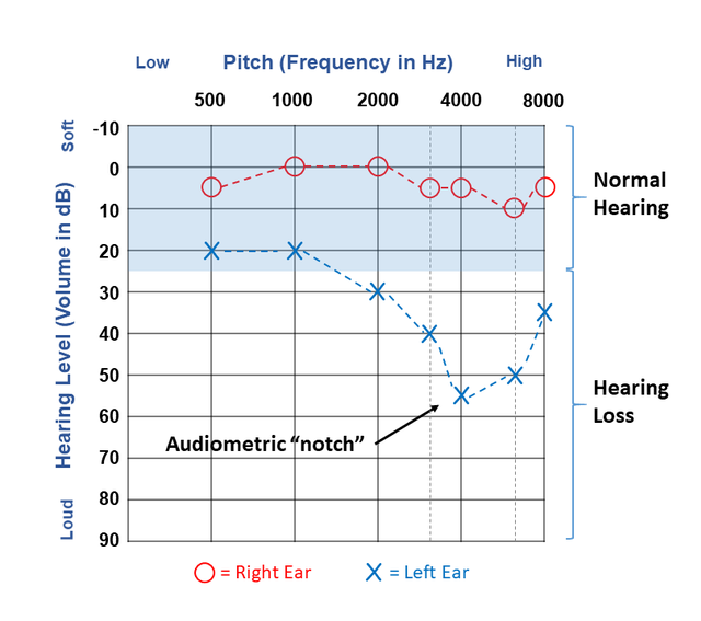 Results of a hearing test plotted on an audiogram illustrating a typical "noise notch" in the left ear