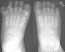 Right-sided duplication of the right little toe in an 8.5 months old male, with two toes (fifth and sixth) apparently forming joints with the fifth metatarsal bone, which is mildly broadened distally. The duplicated toes have almost normal growth. The fifth toe has mild varus angulation, and the sixth toe has substantial valgus angulation. X-ray of feet in polydactyly.jpg