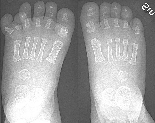 Right-sided duplication of the right little toe in an 8.5 months old male, with two toes (fifth and sixth) apparently forming joints with the fifth me
