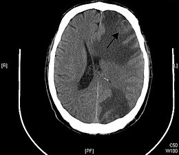 Description de l'image Brain - CT scan - Metastatic pulmonary adenocarcinoma Case 239 (7603361920).jpg.