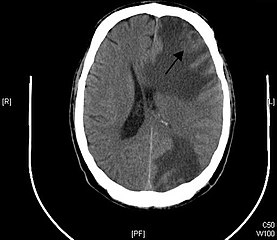 "Brain - CT scan - Metastatic pulmonary adenocarcinoma"