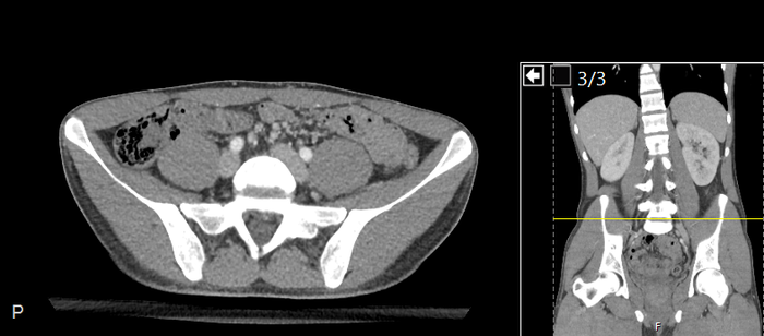 CT of a normal abdomen and pelvis, axial plane 182.png
