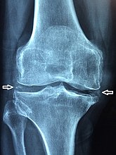 X-ray of a knee with chondrocalcinosis.