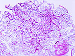 http://upload.wikimedia.org/wikipedia/commons/thumb/f/f6/Esophageal_candidiasis_%281%29_PAS_stain.jpg/150px-Esophageal_candidiasis_%281%29_PAS_stain.jpg