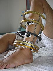 An Ilizarov apparatus treating a fractured tibia and fibula.
