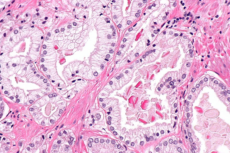 File:Intraluminal eosinophilic crystalloid of prostate gland - high mag.jpg