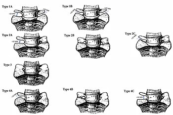 Schematic presentation of the classification of unilateral and bilateral LSTV according to the proposed Jenkins classification Jenkins Classification.jpg