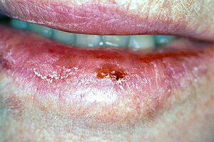 Ulceration on the left lower lip caused by cancer