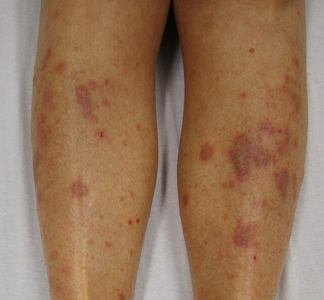 29 Year Old White Female with Grouped Blisters on Left Thigh