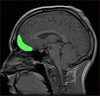 MRI of orbitofrontal cortex.jpg